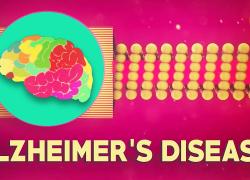 Embedded thumbnail for Alzheimer's Disease Video